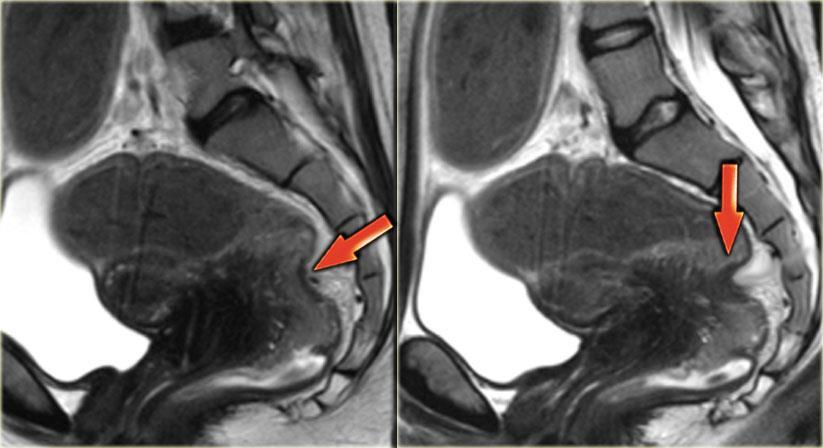 léze postihující rektum a sigmoideum http://www.radiologyassistant.