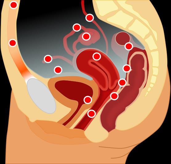 Endometrióza Přítomnost endometriální tkáně mimo děložní dutinu Během menstruačního cyklu dochází k cyklickému krvácení a