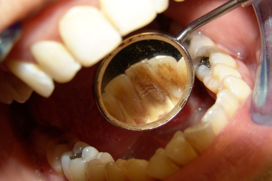 Jak zjistit biofilm na zubní sklovině Dobrovolník má