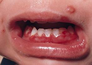 3.4.2 Gingivostomatitis herpetica Herpetická gingivostomatitida je primární infekcí virem herpes simplex. Nejčastěji se vyskytuje u dětí a to v prvních letech po narození.
