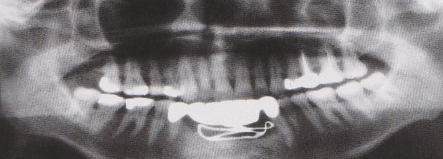 Odborný asistent kliniky Sedláček zaváděl implantáty potají a to proti vůli vedení kliniky. U zkrácených zubních oblouků obou čelistí vyráběl subperiostální implantáty.