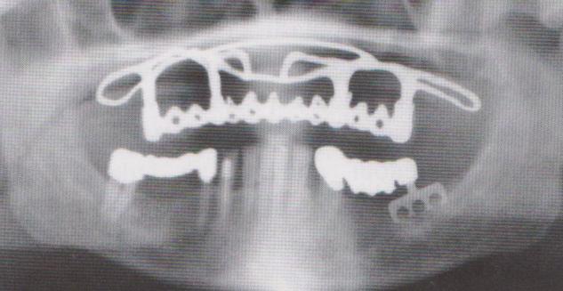 Na pracovním modelu se vytvoří voskový model implantátu a následně se odlije z kovu. Při dalším zákroku se mukoperiost odklopí a zavede se implantát mezi periost a alveolární kost.