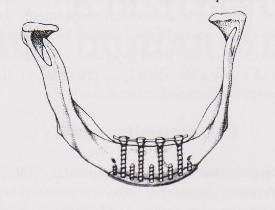 2.4 Transmandibulární implantáty Transmandibulární implantáty se řadí do skupiny intraoseálních implantátů.