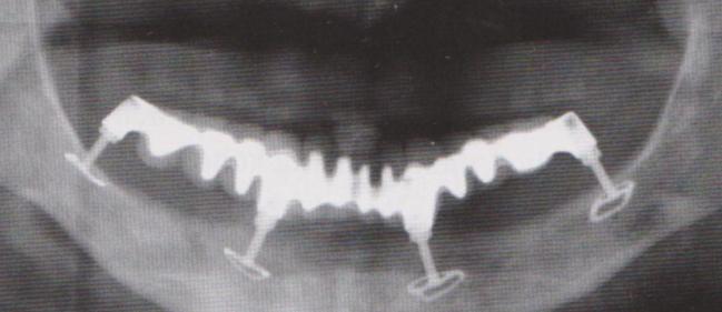 Obrázek 18 Diskové implantáty (3) Obrázek 19 Diskové implantáty v dutině ústní (3) Diskové