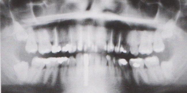 10 Indikace v dentální implantologii 10.