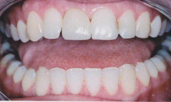 Je zde tedy větší riziko selhání implantátu z důvodu přetížení.