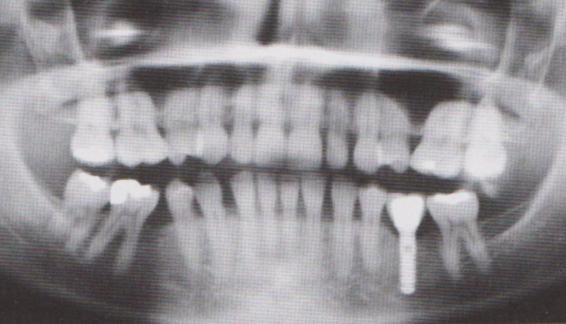 přetížení implantátu.