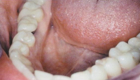 omezíme zatížení implantátu žvýkacími silami (Obrázek 27).