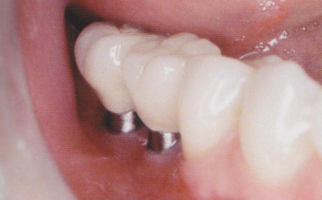 Suprakonstrukce mají bránit přetížení fixtur a nesmí znemožňovat čištění implantátu.
