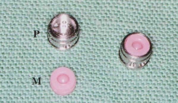 desky. Pvním řešením je kulový attachment. Kovová patrice je součástí implantátu a matrice je plastová.