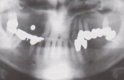 12.3 Předoperační analýza Předoperační analýza se skládá ze tří částí: 1. Zmapování nabídky alveolární kosti 2. Plánování implantací a suprakonstrukce 3.