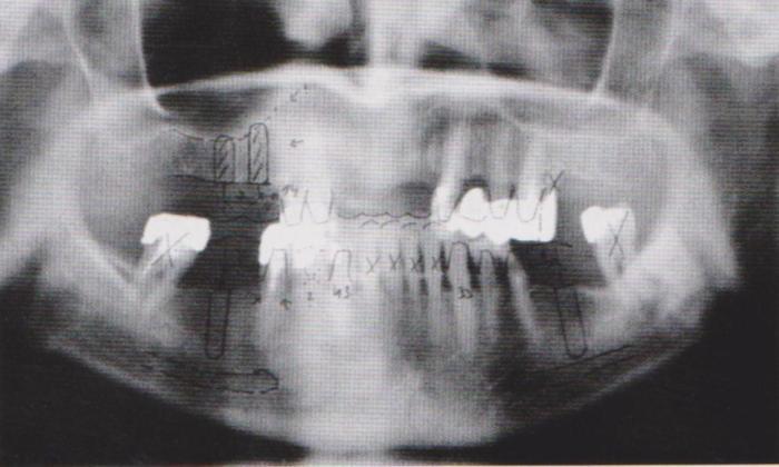 2. Po zmapování nabídky alveolární kosti začneme přemýšlet o typu, povrchové úpravě a rozmístění implantátů.