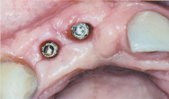 Obrázek 65 Krčkové části implantátů