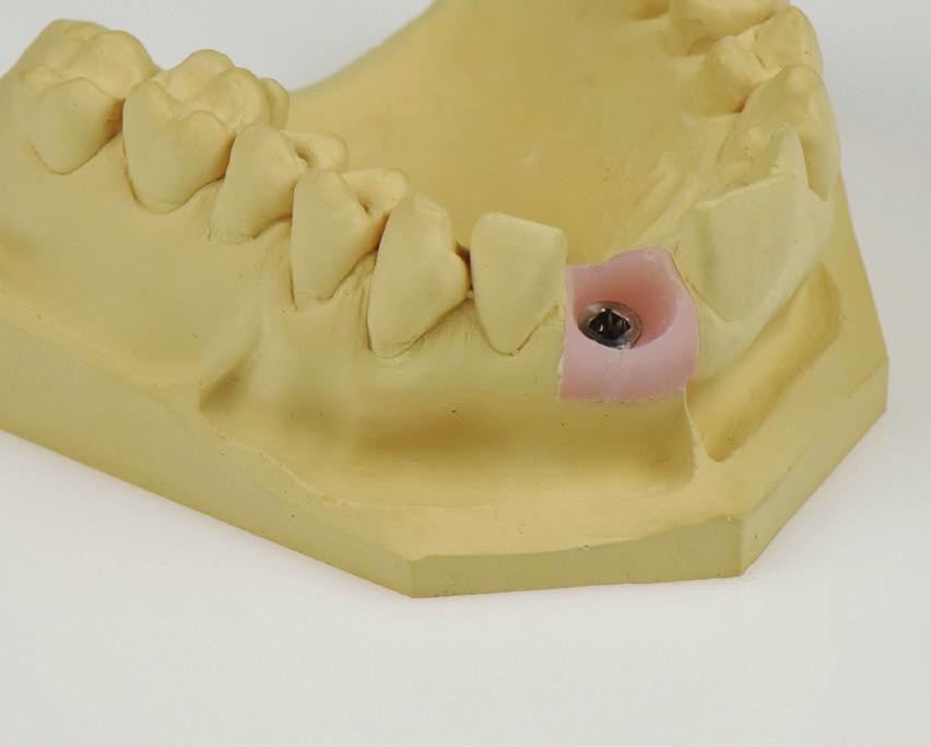 2. Laboratorní zpracování Straumann Variobase 2.1 Preparace Předpoklady Odstín zubu by měl být určen a zaznamenán (odstín by měl být určen dle manuálního vzorníku nebo pomocí intraorálního skeneru).
