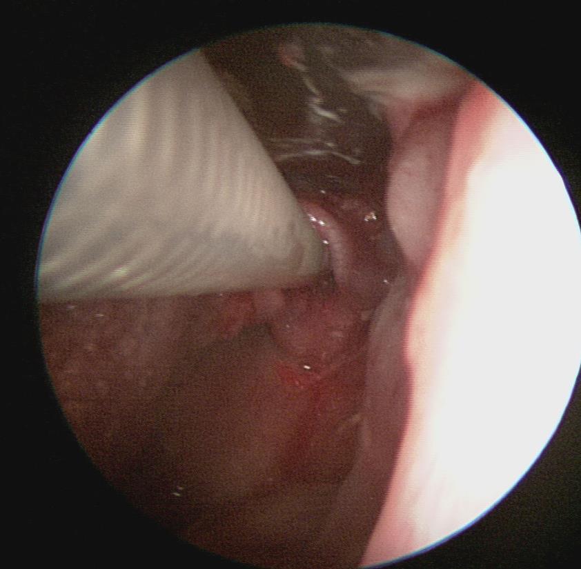 Opakované intubace