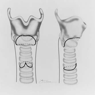 Otevřená chirurgie 1/ Augmentace grafty,