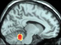 (vlevo) a opravdovém (vpravo) - rozsáhlá deaktivace mozku ve vědomé části při