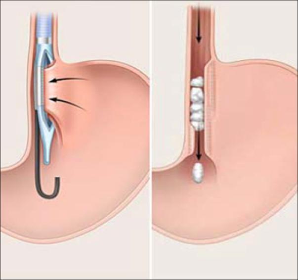 11: endoskopická vertikální gastroplastika Endoskopická staplerová vertikální gastroplastika Endoskopická staplerová gastroplastika vychází z historicky úspěšné vertikální bandážované gastroplastiky