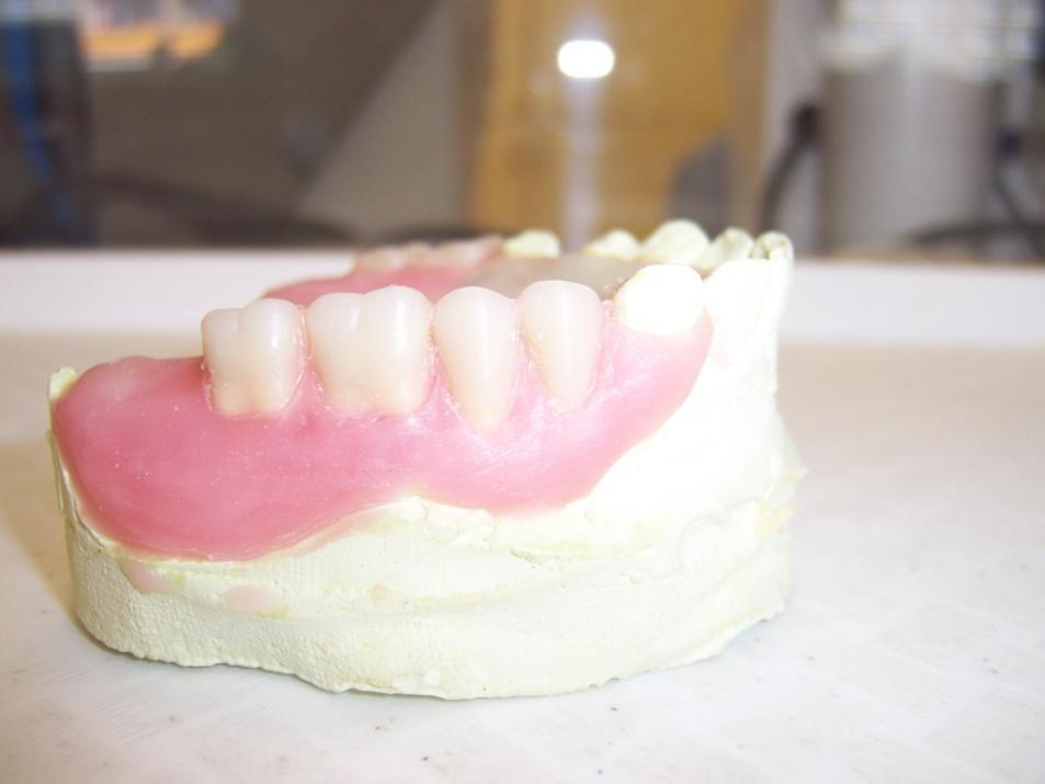 Zkouška zubů ve vosku Kyvetování Bazi přikapeme k modelu. Vymodelujeme spony, jejichž rozsah nám určuje vykrytí.