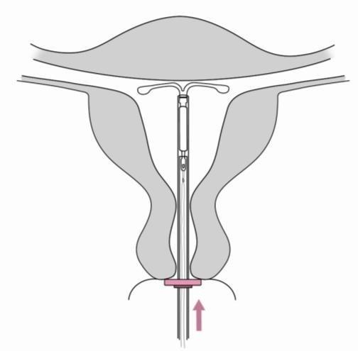 6. Šetrně vtlačte zavaděč směrem k fundu dělohy, až se zarážka dotkne čípku. Nyní je Jaydess ve fundu (obrázek 6). Obrázek 6 7.