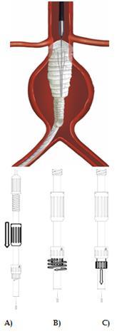 11.8.7 Manipulace s ipsilaterální nožkou Manipulujte se zbytkem ipsilaterální nožky vysouváním ovládání pouzdra směrem k distálnímu konci držadla (viz Obrázek 6) Manipulace s aortální částí