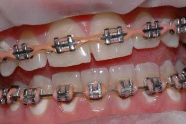 plochách. Byla provedena opět důkladná remotivace a reinstruktáž, profesionální čištění a leštění zubů a fluoridace fluoridovým lakem (Bifluorid 10).