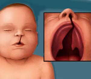 Obr. č. 2 Úplný levostranný rozštěp Zdroj:http://www.tour2indi a4health.com/pic/fl7_cleft_ palate.jpg Obr. č. 3 Úplný oboustranný rozštěp Zdroj: http://www.jclpca.