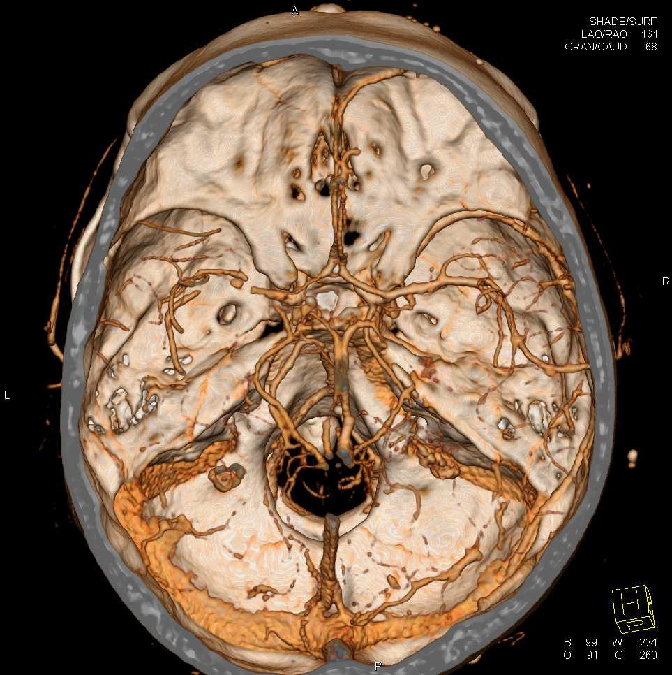 CT angiografie v rozsahu od oblouku aorty po vrchlík byly provedeny za použití duální energie 140-kV a 80-kV. Kolimace byla opět 2 (32 0.
