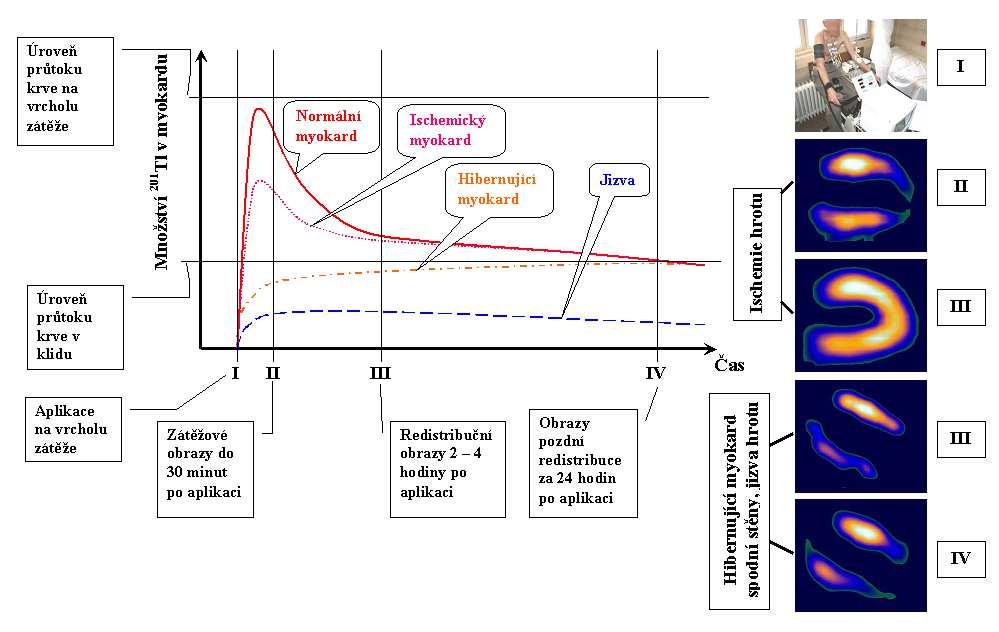 Perfuze myokardu patofyziologie Perfuze při p i koronárn rní ateroskleróze v klidu Fyziologická kompenzační dilatace arteriol v povodí zásobeném m zúženou z tepnou Průtok krve tkání je stejný jako v