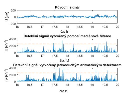 Obrázek 3.19: Ukázka reakce kombinovaného detektoru na EMG artefakt. Společná detekční mez je nastavena na 2500 μv 2. Obrázek 3.