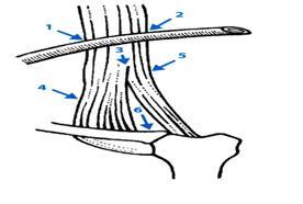 Obr. 13 Přístupové cesty do vena jugularis přístupové cesty do centrální ţíly punkce vena jugularis : 1 horní laterální přístup, 2 horní mediální přístup, 3 centrální přístup, 4 dolní laterální