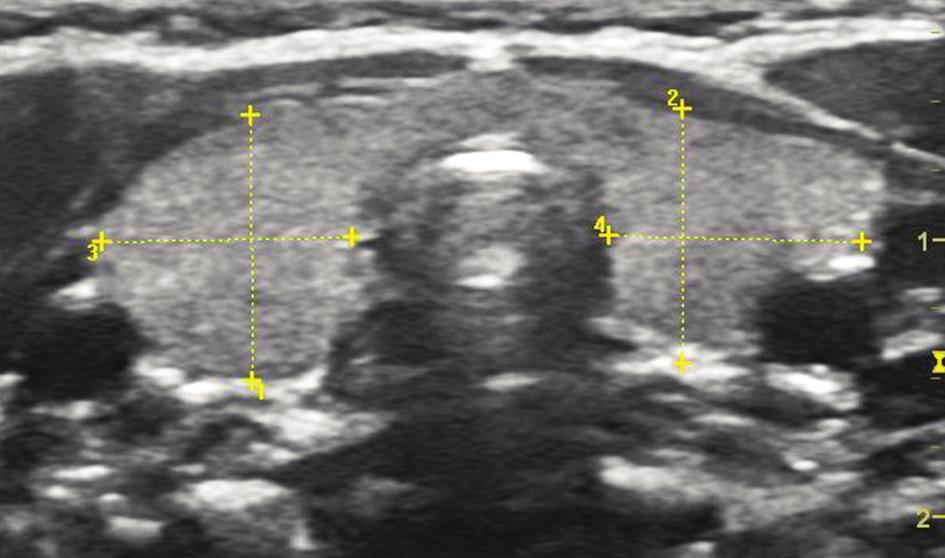 Na EKG patrný sinusový rytmus s tachykardií 170 190/min. Struma nebyla patrná, lehce byl naznačen exoftalmus ( obrázek č. 1). Oční vyšetření potvrdilo mírný axiální exoftalmus.