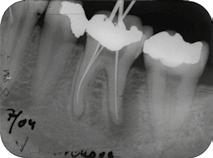 Na kontrolním snímku zubu 36 jsme objevili rozsáhlý periapikální nález především u distálního kořene (obr. 1). Dne 16.