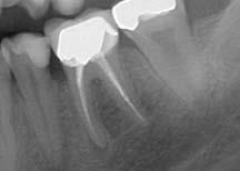 zbytek kavity byl vyplněn amalgámem. Dne 20. září 2005 byl zub 36 nabroušen schůdkovou preparací a 3. října 2005 nacementována metalokeramická korunka.