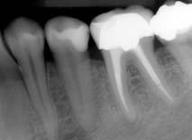 tém, protože v hloubce endodontické kavity není většinou možné dosáhnout dostatečné fotopolymerace. Ad 3: Podle kontrolních RTG zubu, které jsou z roku 2010 (viz obr.