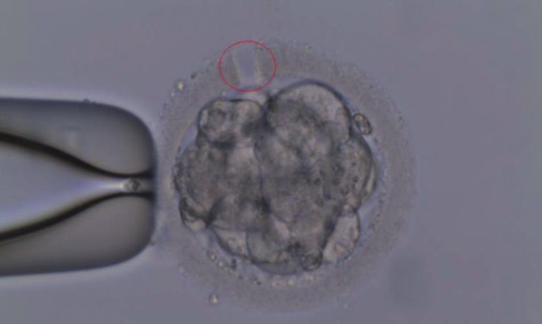 Transfer embryí do dělohy ET Doporučujeme zavedení jednoho embrya jako prevenci vícečetného těho ten - ství.