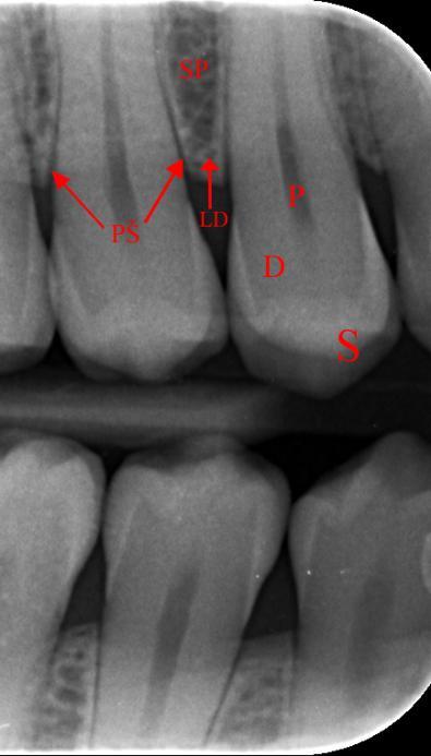 4. RTG diagnostika kazu S sklovina D dentin P pulpa LD lamina dura PŠ Parodontální štěrbina SP - spongióza Obrázek 17 Rentgenový popis zubu (20) Rentgenové (RTG) vyšetření je indikováno vždy, kdy