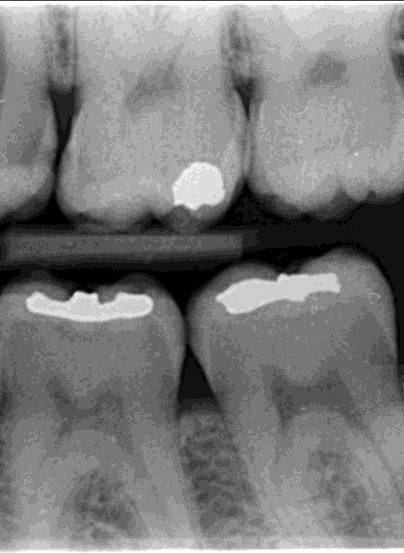 sekundární kazy pod výplněmi, okolo výplní. Aproximální kaz Kaz na bočních stranách zubu v mezizubním prostoru. Nejčastější výskyt kazu je v oblasti kontaktních bodů a v okolí kontaktů zubu.