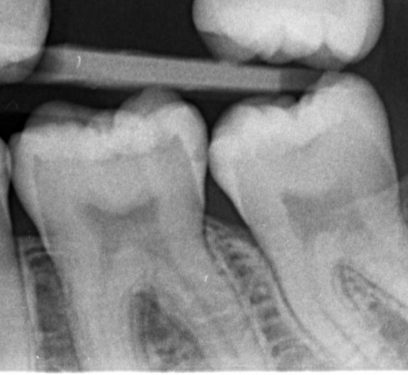 Obrázek 19 Léze na dentino-sklovinné hranici (20) Léze v dentinu Kaz, který poškodil celou vrstvu sklovinu, se šíří do dentinu.