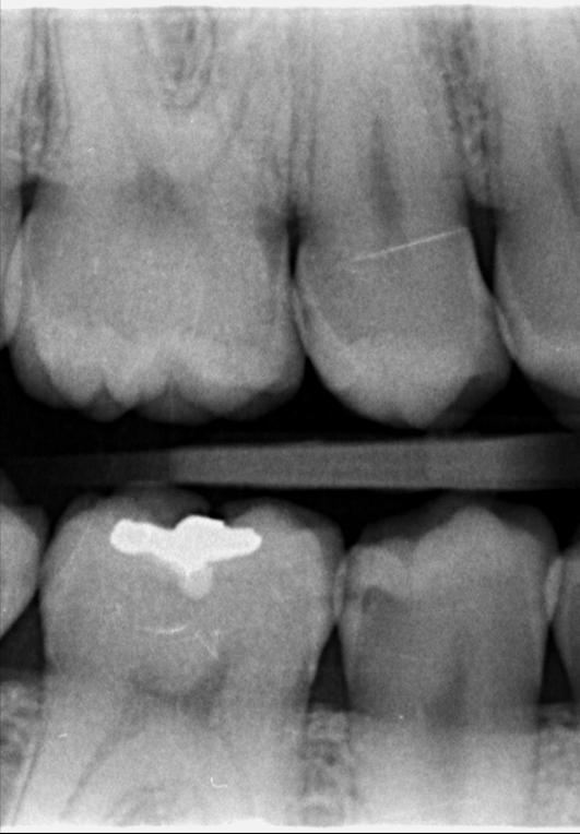 Tak jako ve sklovině, tak v dentinu je zobrazení kazu na rtg vždy menší, než je poškození zubu ve skutečnosti (obr. 8).