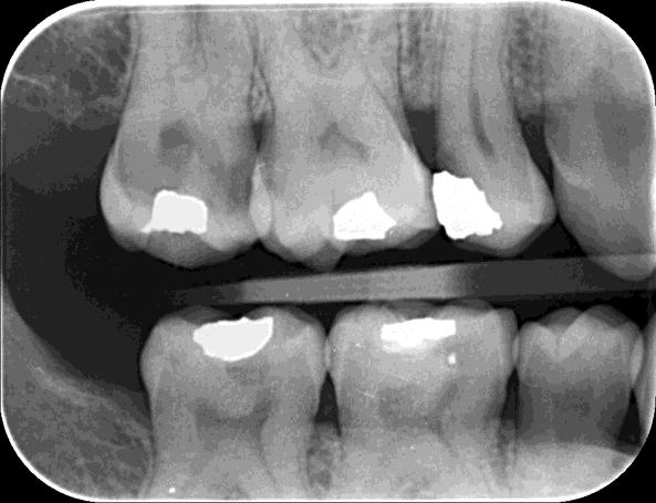 zubu, vrstvou skloviny, případně dentinu. Znázornění začínajícího kazu není možné, protože léze je na snímku překrytá silnější vrstvou zdravé skloviny.