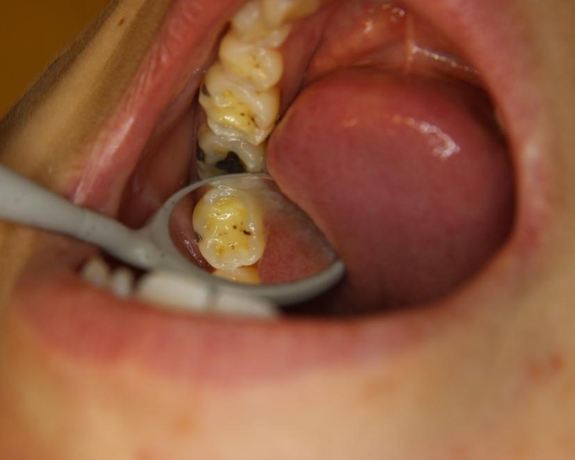 Obrázek 33 Eroze (3,15) 5.2.2 Mechanické opotřebení zubů Traumatické změny skloviny mohou vznikat v důsledku fyziologického opotřebení, nebo působením jinými fyzikálními silami než je okluze.