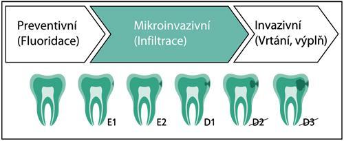 Kontraindikace Mikroinvazivní léčbu neprovádíme u kazu přesahující 1/3 dentinu (D2, D3) anebo na kavitovanou sklovinu. Není dovoleno materiál používat na obnažený dentin nebo cement.