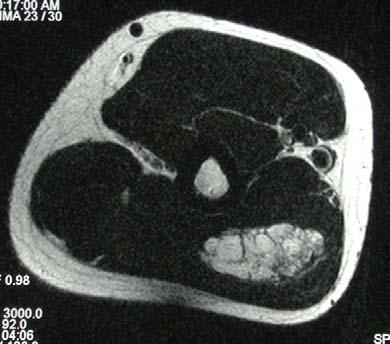 Fibromat.