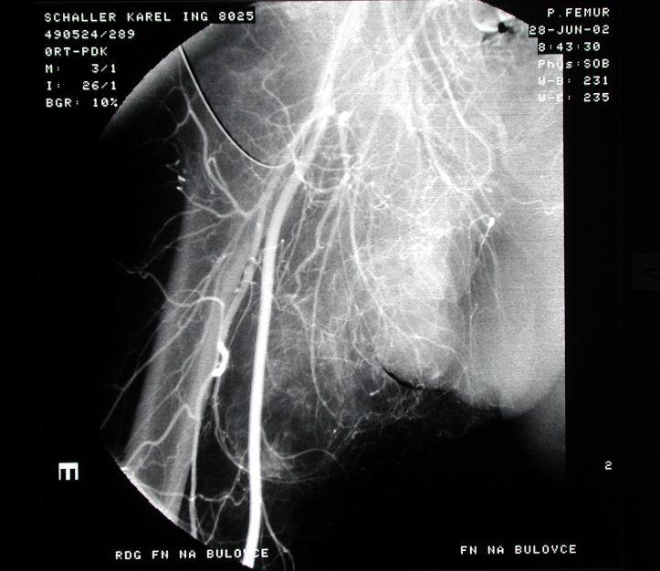 Angiografie Vzhledem k invazivitě