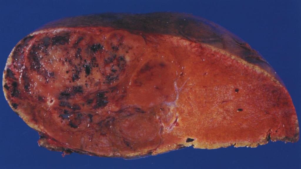 Adenom makroskopické znaky Většinou solitární tumory (80%) velikosti 5 20 cm Tumory dobře ohraničené, většinou neopouzdřené Barva tumoru