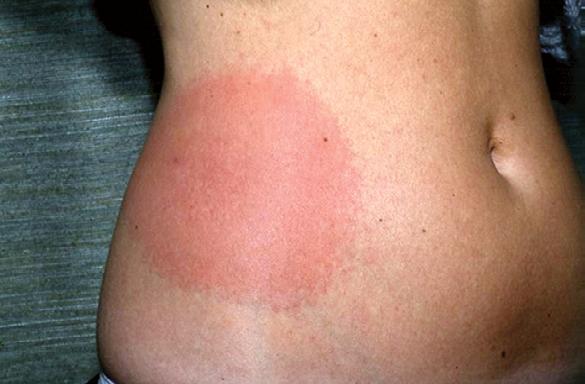 e19 Obrázek 4. Erythema migrans maculare (7) Obrázek 6. Erythema migrans concentricum (8) Obrázek 5.