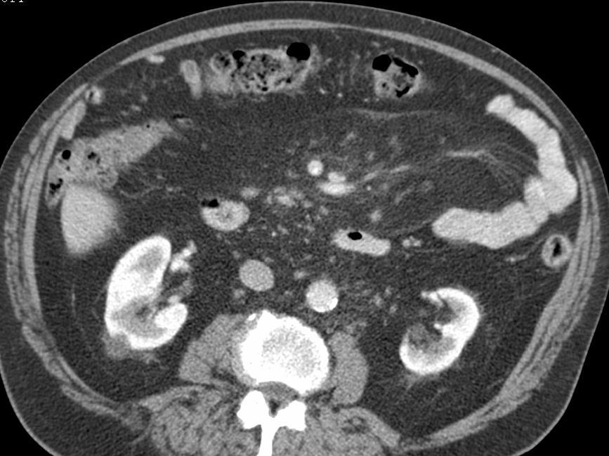 Mesenterium Klinická diagnoza