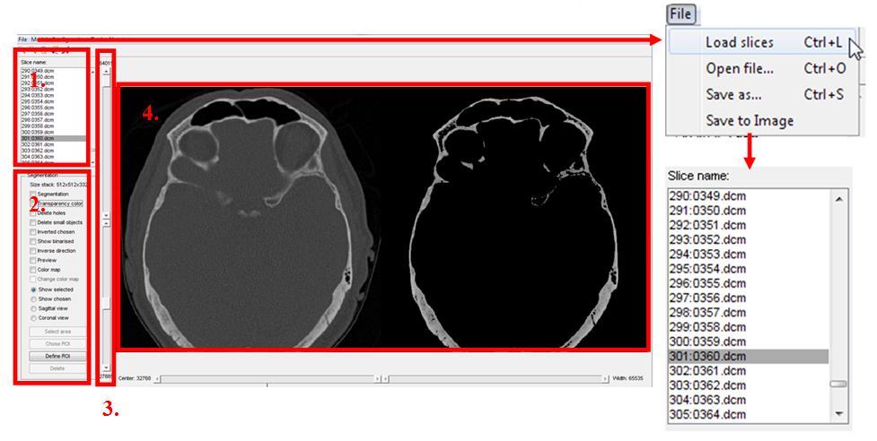 Kombinací výše zmíněných metod vzniká silný nástroj pro vytváření STL modelů v biomechanice.