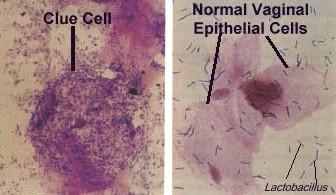 Clue cells http://www.kcom.